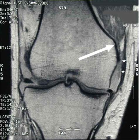 proximal medial collateral ligament tear